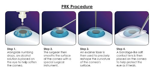 A drawn diagram showing a close-up of an eye and the four steps of the PRK procedure