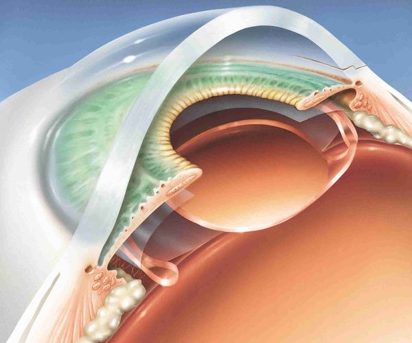A drawn rendition of the layers of a cross-section of an eyeball