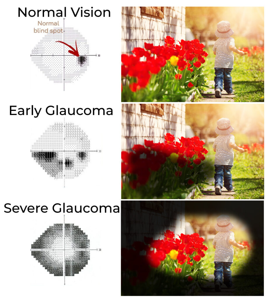 The same image shown three times with normal vision, a filter mimicking early glaucoma, and a filter showing restricted vision as with severe glaucoma