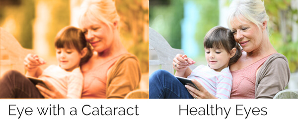 The same image is shown twice, once with a filter mimicking discoloration caused by a cataract, with the other showing healthy vision