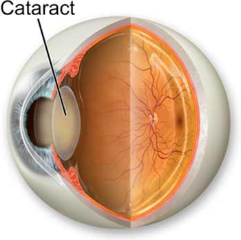 Diagram of an eyeball with a cataract demonstrated
