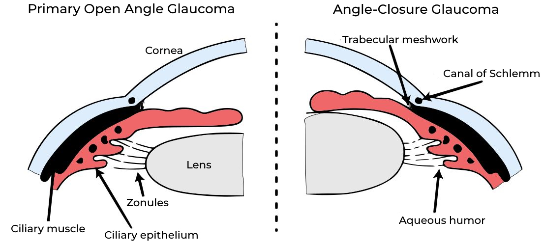 A diagram demonstrating an eyeball with primary open angle glaucoma and angle-closure glaucoma