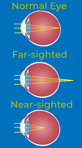 A diagram demonstrating how light refracts differently in eyes that are far-sighted, near-sighted, or have normal vision