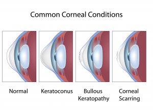 Common Corneal Conditions