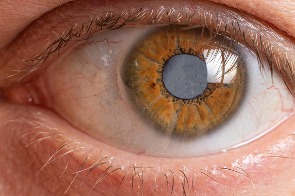 The Difference Between Cataracts And Glaucoma Anderson And Shapiro Eye Care