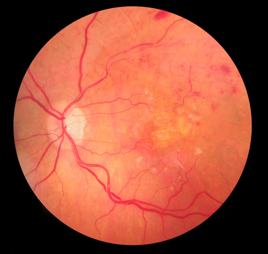 A photograph of an eye with blood vessel damage from diabetes. 